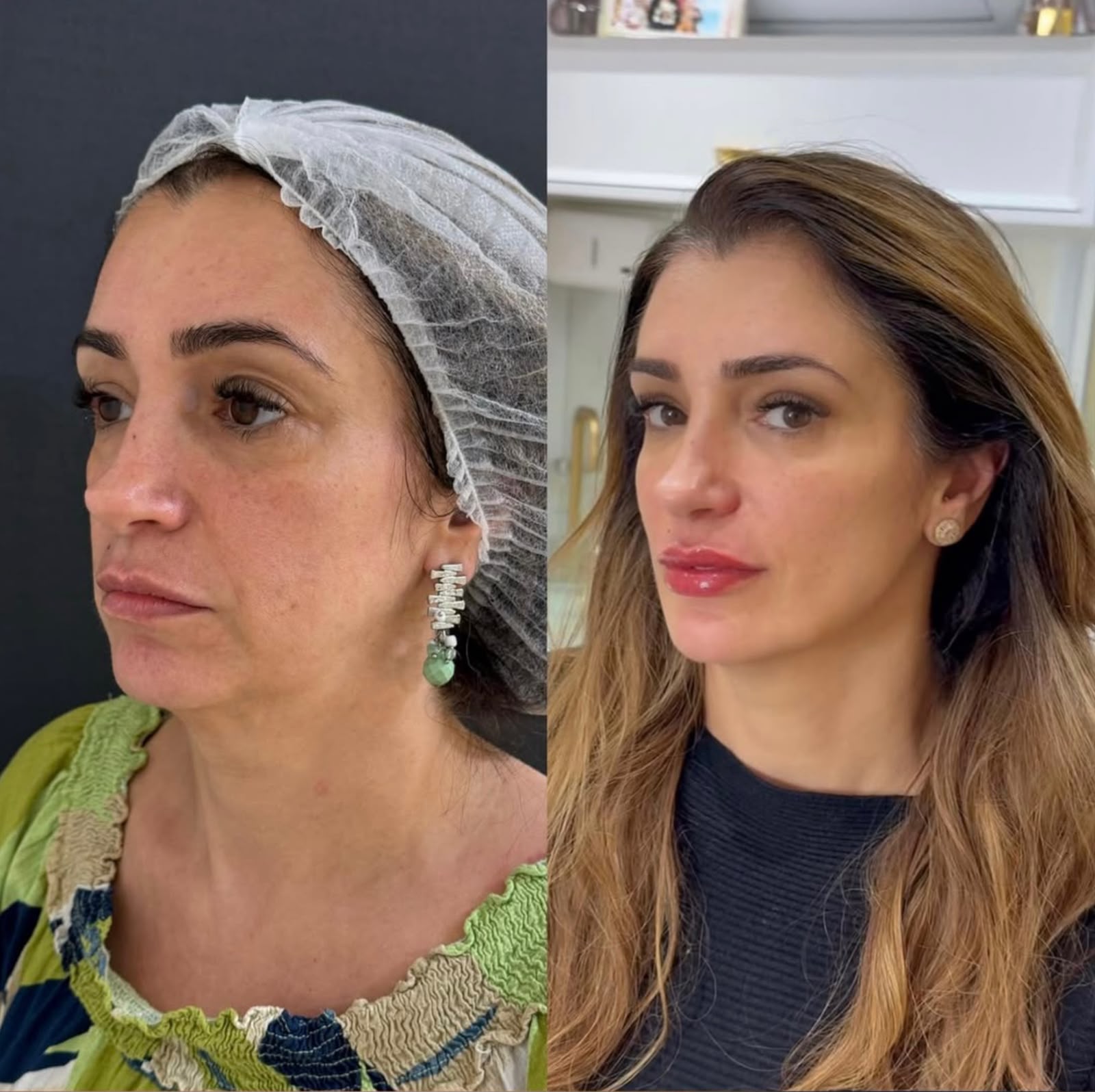 Resultado de harmonização facial 1