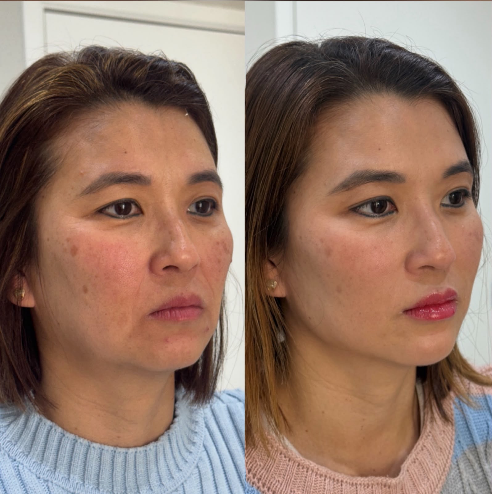 Resultado de harmonização facial 2