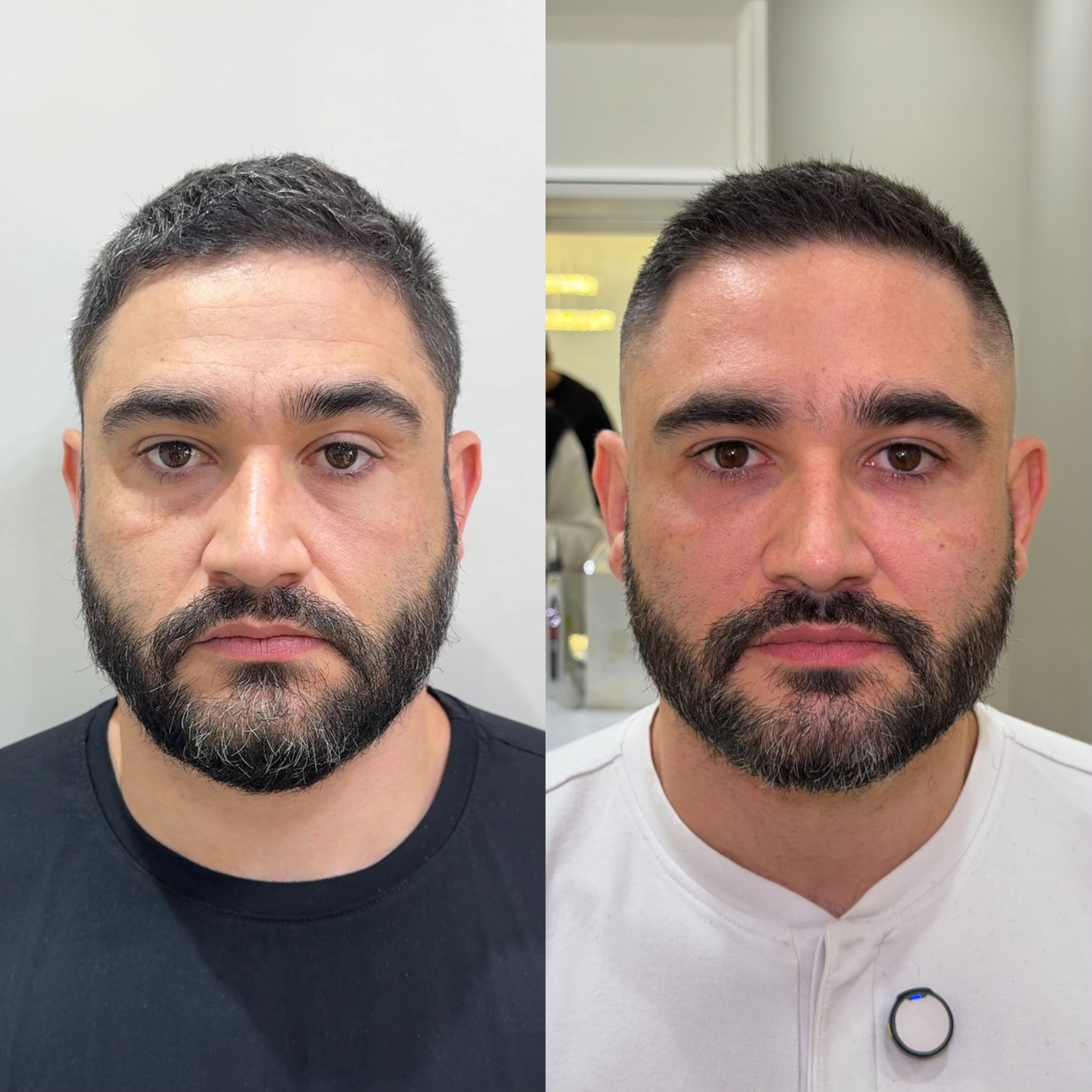 Resultado de harmonização facial 3
