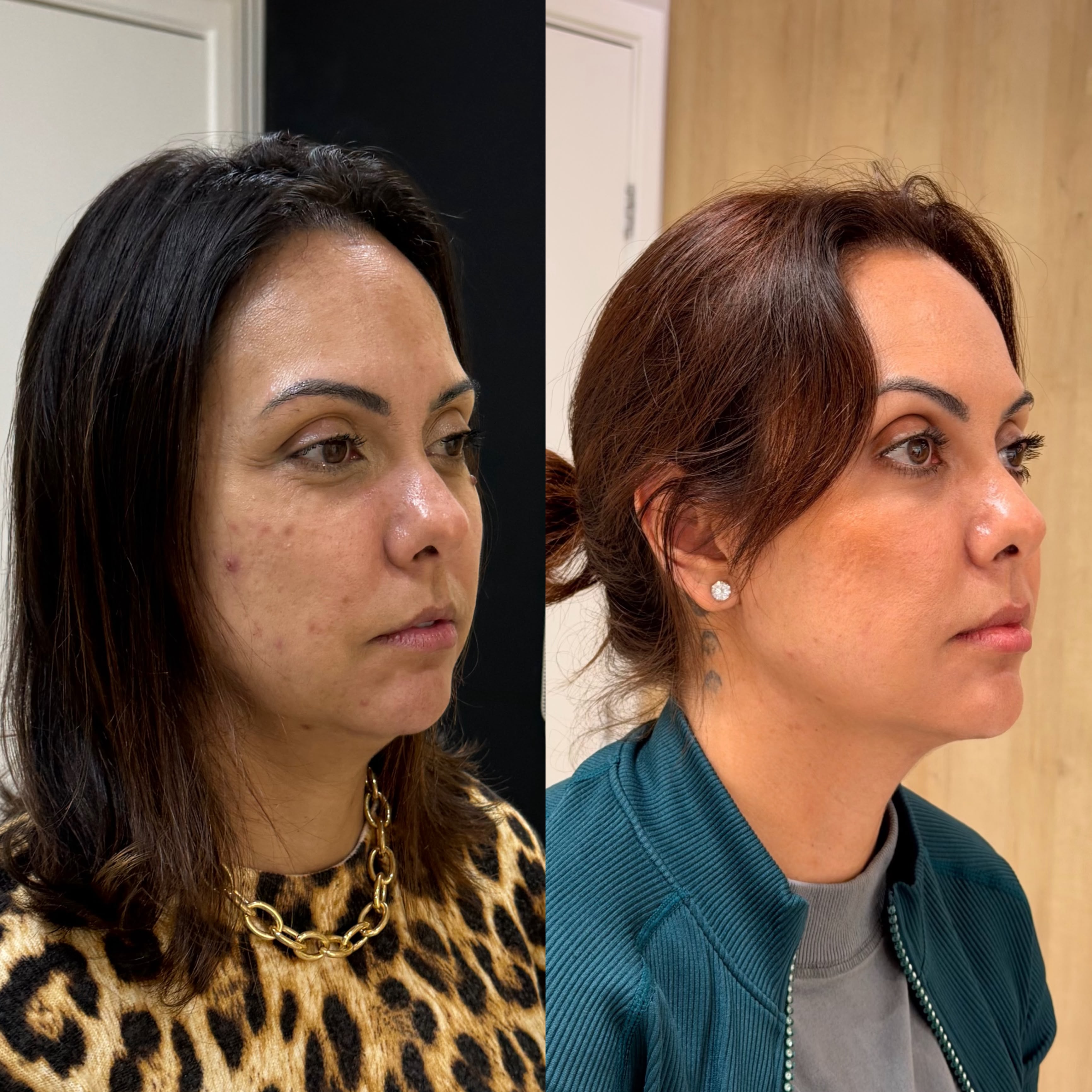 Resultado de harmonização facial masculina
