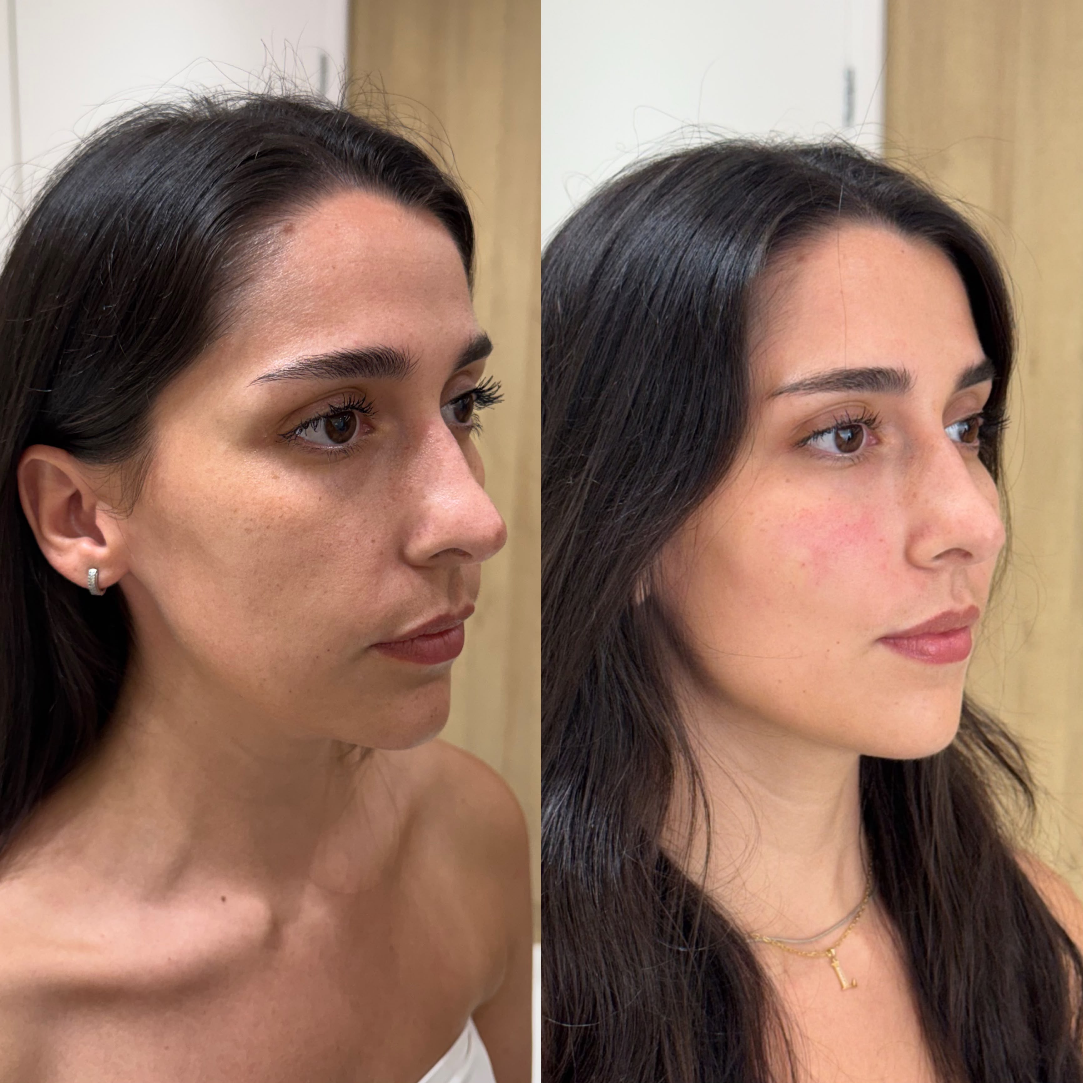 Resultado de harmonização facial 5