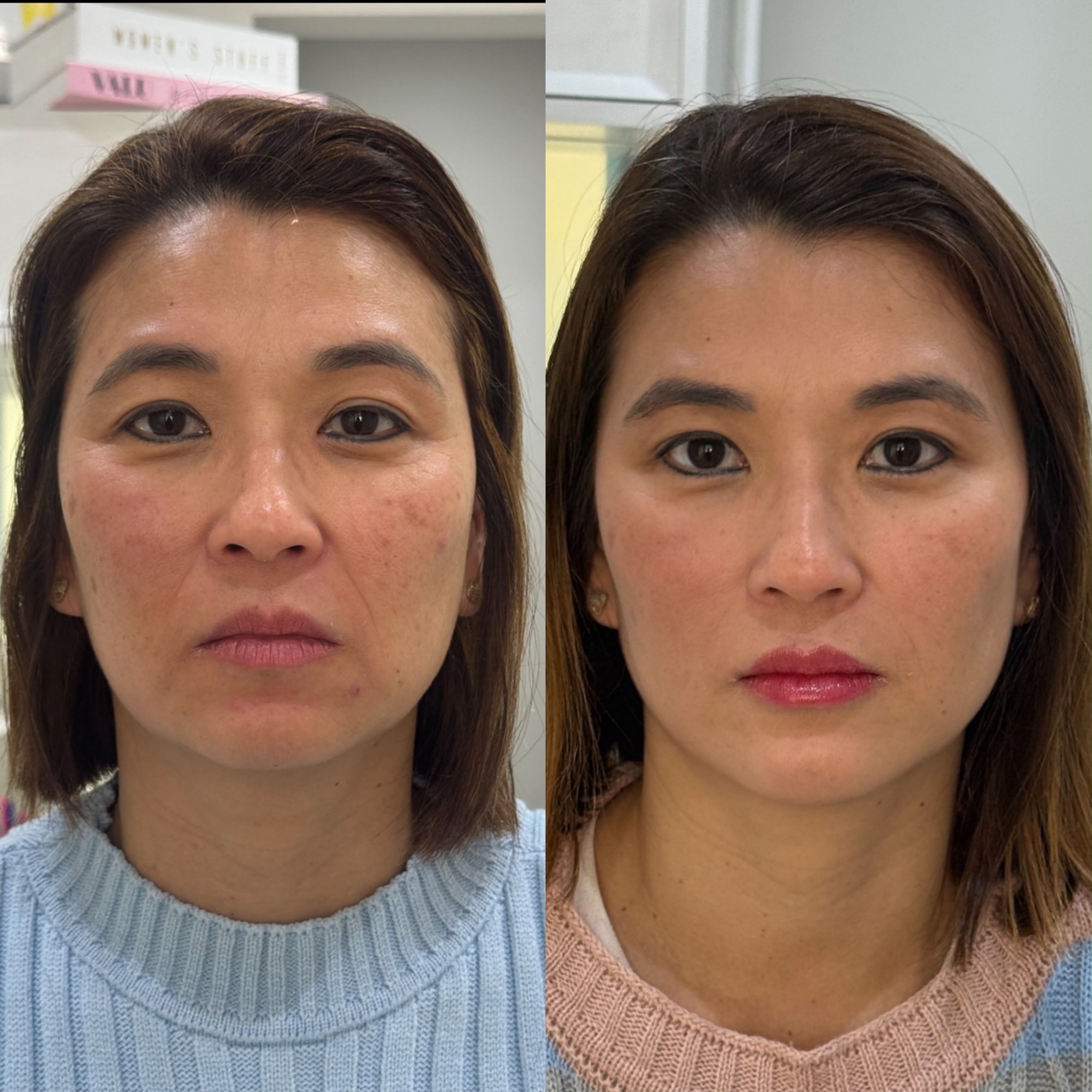 Resultado de harmonização facial 6