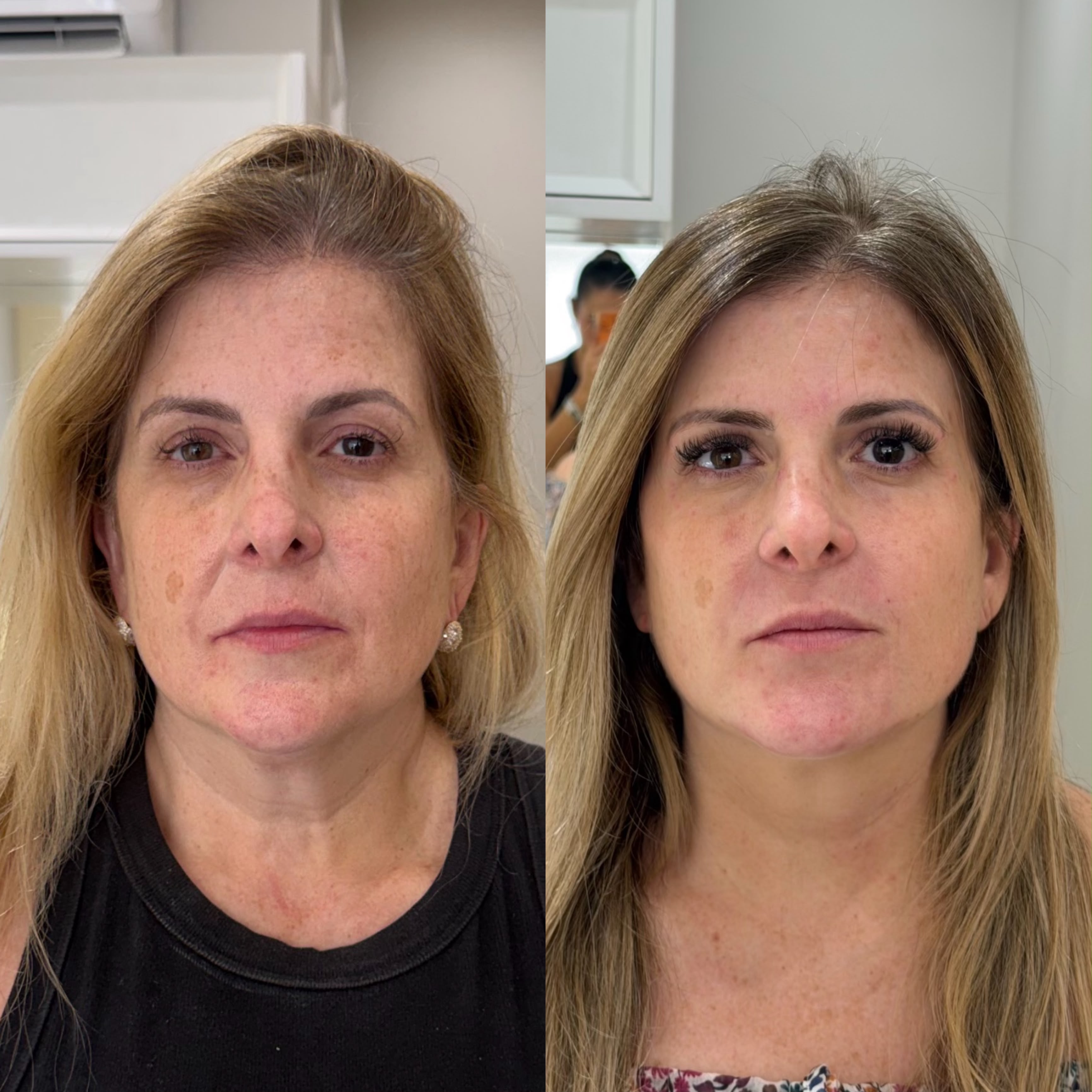Resultado de harmonização facial 7